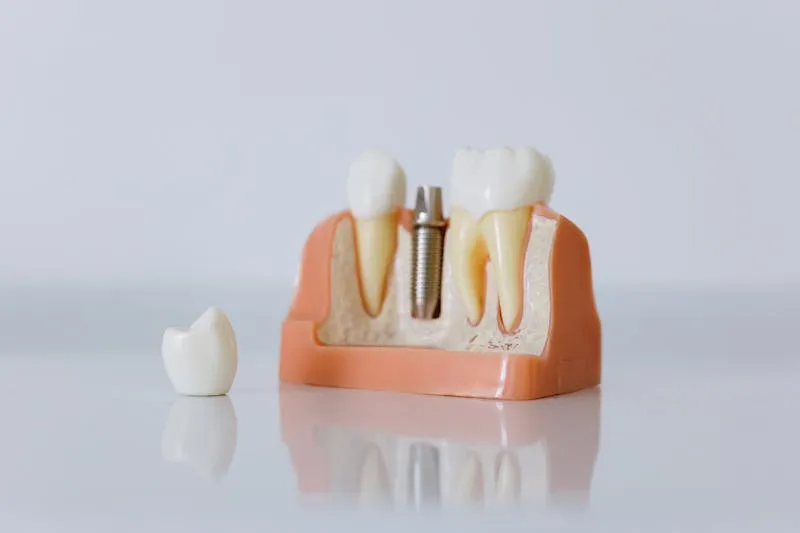 Dental implant model showing titanium post and crown components