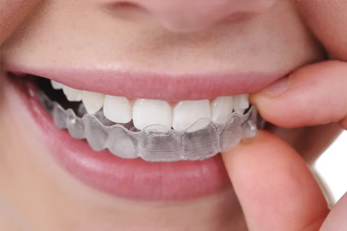 Invisalign clear aligners for teeth straightening