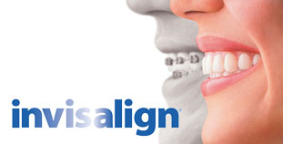 invisalign